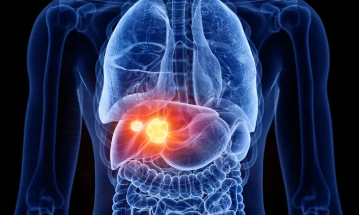 Fatty Liver Disease Affects 1 in 3 Americans: Tips to Reverse It Naturally