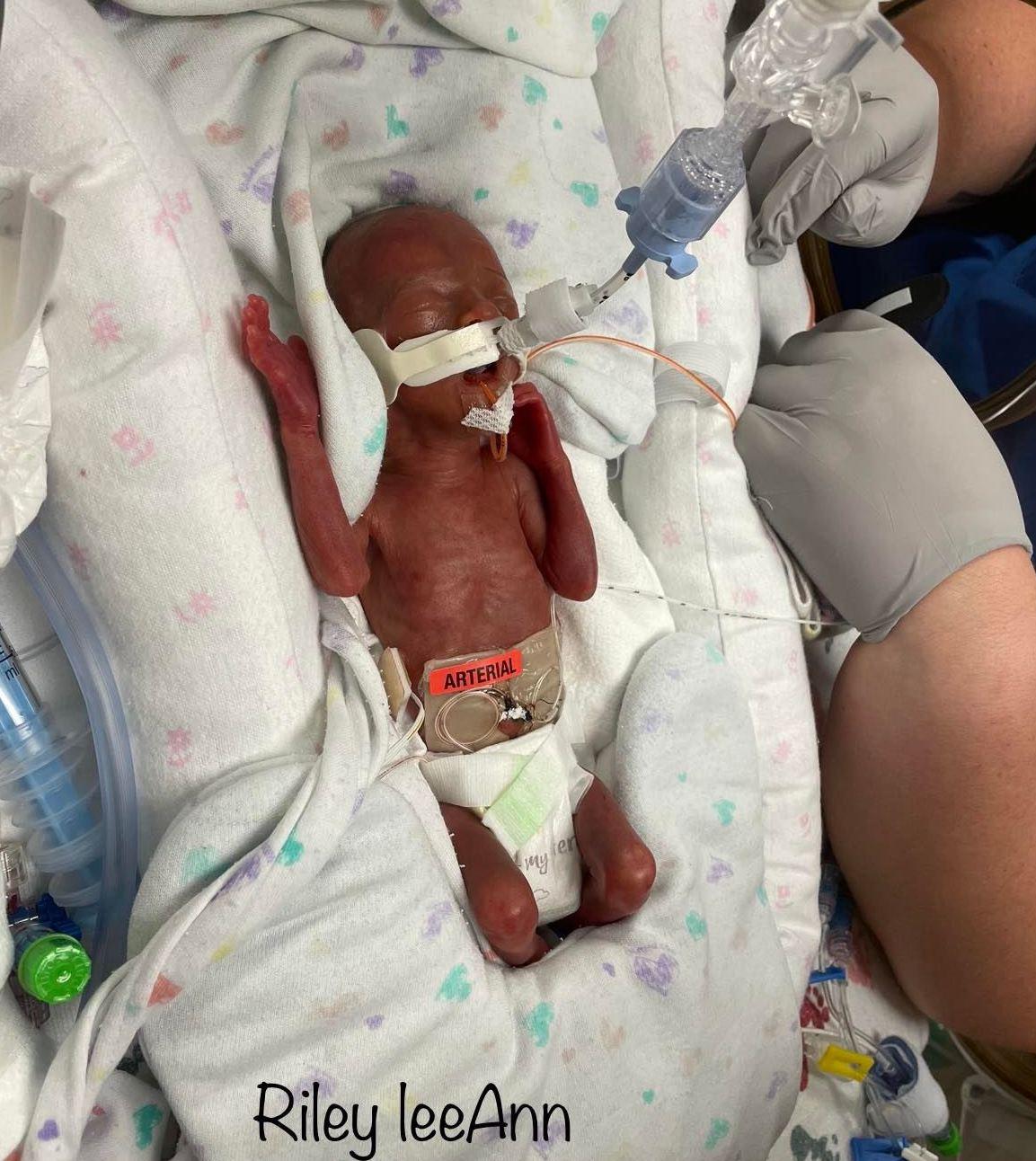 Riley was born at 22 weeks and 4 days' gestation. (Courtesy of <a href="https://www.facebook.com/megan.kommers.9">Megan Phipps</a>)