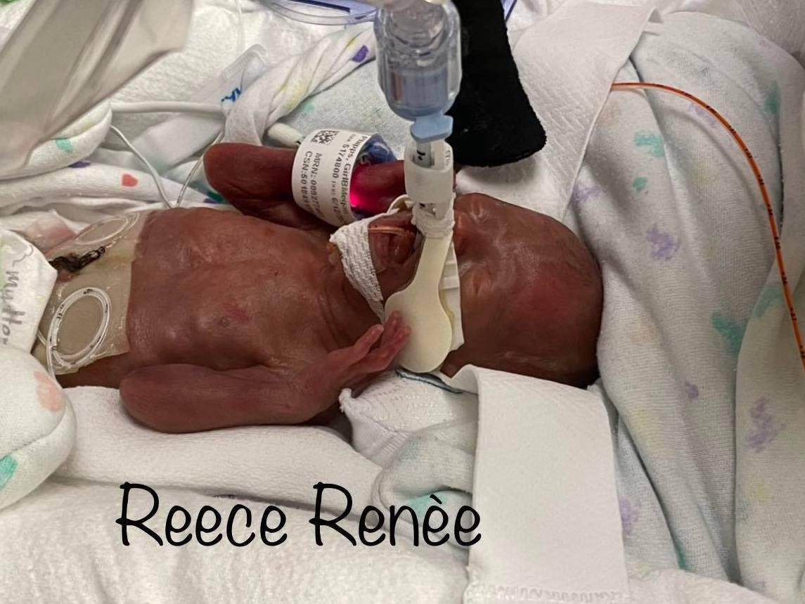 Reece was born at 22 weeks and 5 days' gestation. (Courtesy of <a href="https://www.facebook.com/megan.kommers.9">Megan Phipps</a>)