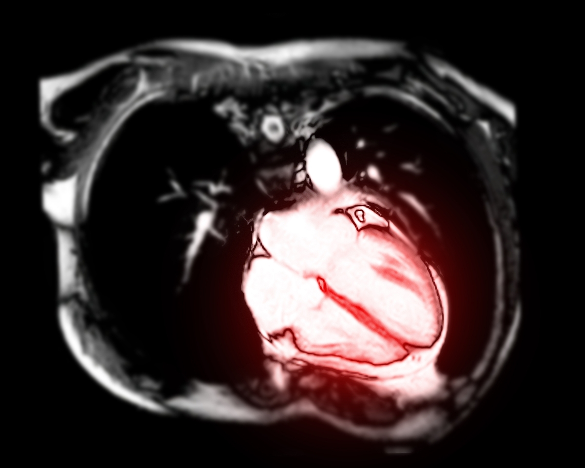 Cardiologist Estimates 30 Percent of US Pilots May Have COVID Jab-Induced Heart Conditions