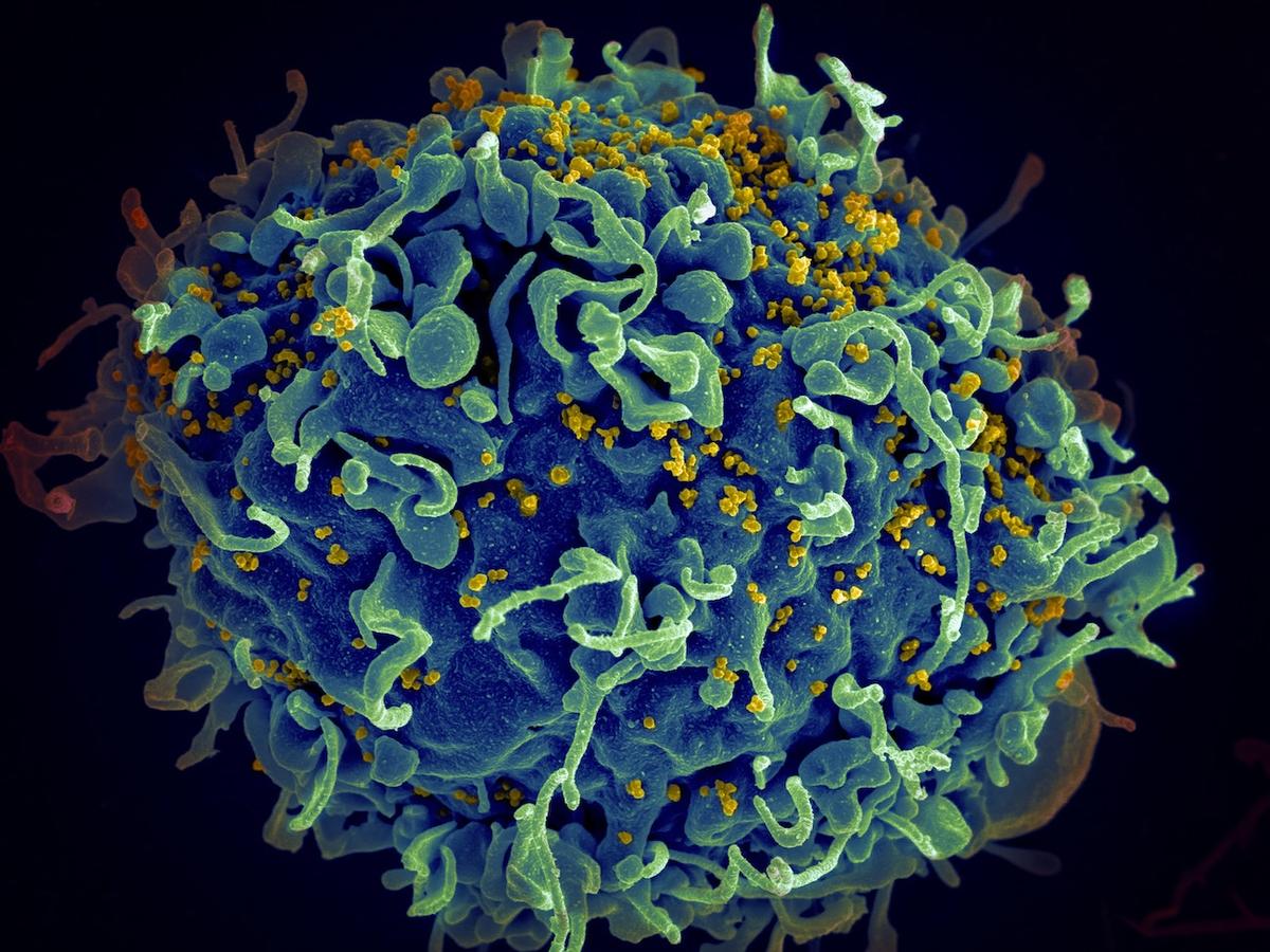 Highly Infectious, More Damaging HIV Variant Found in the Netherlands