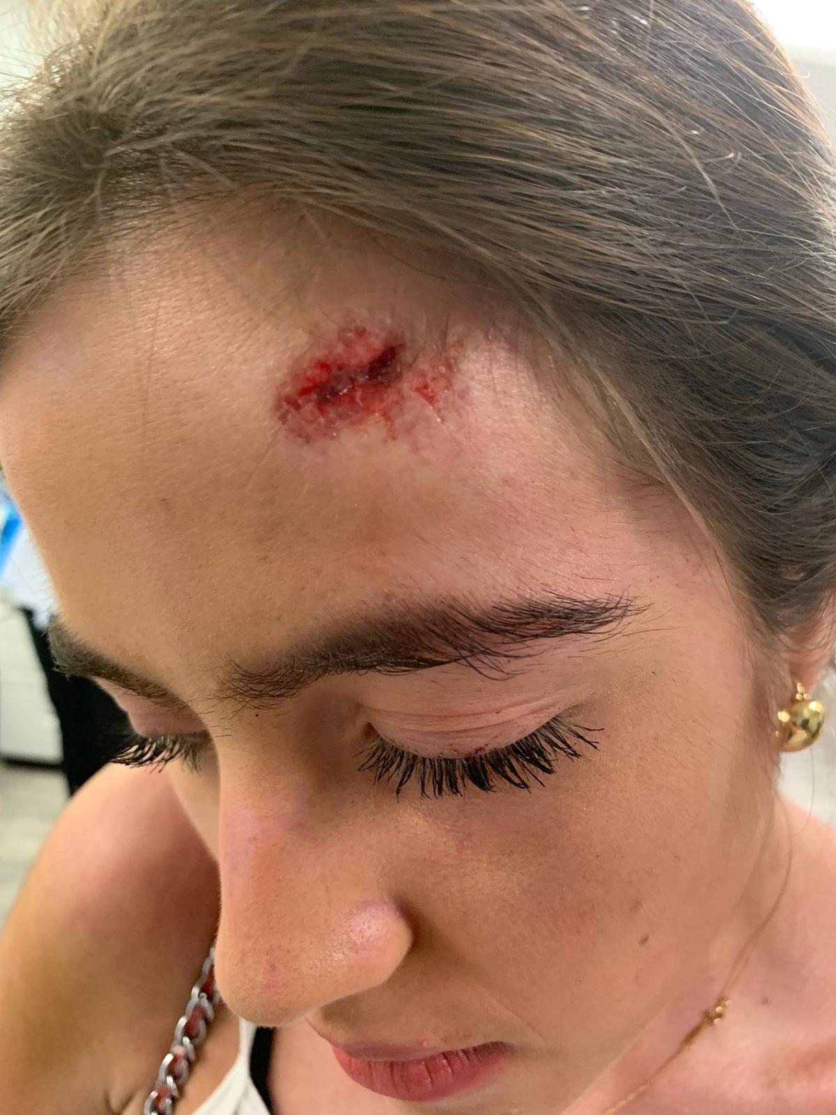 Vanessa von Schwarz after hitting her head. (SWNS)