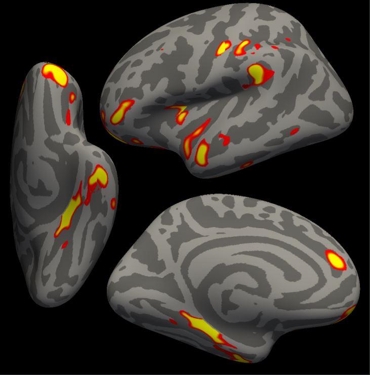 The red-yellow regions are the parts of the brain that researchers found shrunk the most in people who contracted COVID-19, compared with a non-infected cohort. (G. Douaud, in collaboration with Anderson Winkler and Saad Jbabdi, University of Oxford and NIH)