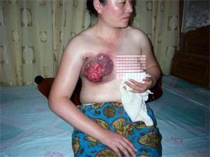 The guards in Masanjia Labor Camp used two high-voltage electric batons simultaneously on Falun Gong practitioner Wang Yunjie's breasts for several hours, causing severe ulceration. She died in July 2006. (Courtesy of Minghui.org)