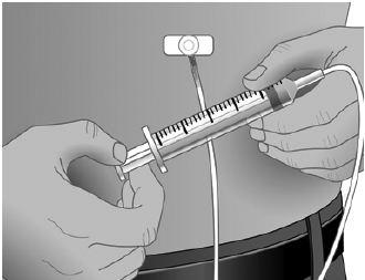 Immunoglobulin is applied subcutaneously in an illustration image. (NIH via The Epoch Times)