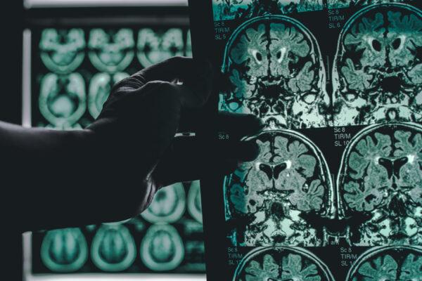 Marijuana reduces blood flow in the parts of the brain affected by Alzheimer's disease. Brain scans of a patient with Alzheimer's disease (Atthapon Raksthaput/Shutterstock)