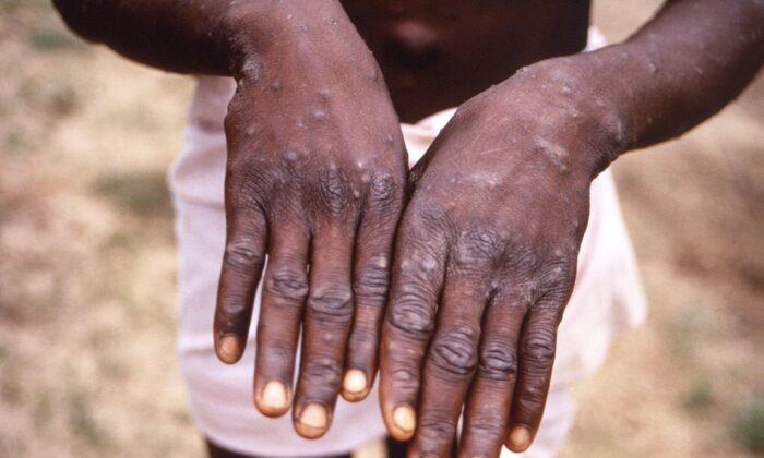 India Reports First Case of Monkeypox