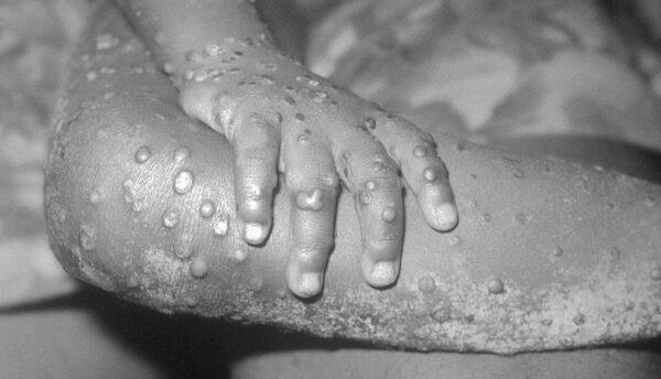 A 1971 photo from the Centers for Disease Control handout shows monkeypox-like lesions on the arm and leg of a female child in Bondua, Liberia. (CDC/Getty Images)