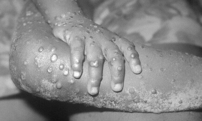 A 1971 photo from the Center For Disease Control handout shows monkeypox-like lesions on the arm and leg of a female child in Bondua, Liberia. (CDC/Getty Images)