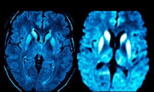 致命的なプリオン脳疾患とCOVIDワクチン:研究がもっともらしい関連性を発見