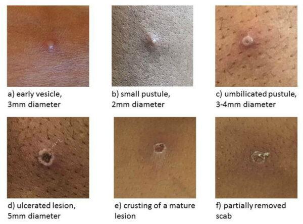 The stages of Monkeypox. (UK Health Security Agency)