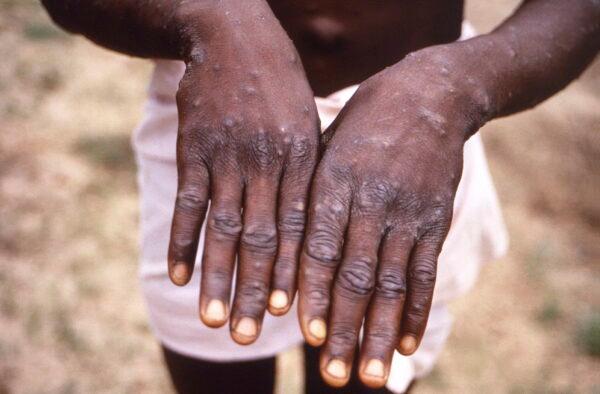 This 1997 image provided by the CDC during an investigation into an outbreak of monkeypox, which took place in the Democratic Republic of the Congo, depicts the dorsal surfaces of the hands of a patient who was displaying the appearance of the characteristic rash during its recuperative stage. (CDC via AP, File)