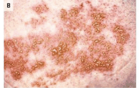  Screenshot of a shingles rash with clusters of blisters. (<a href="https://www.cdc.gov/mmwr/preview/mmwrhtml/rr5705a1.htm">CDC MMWR</a>/screenshot by The Epoch Times)