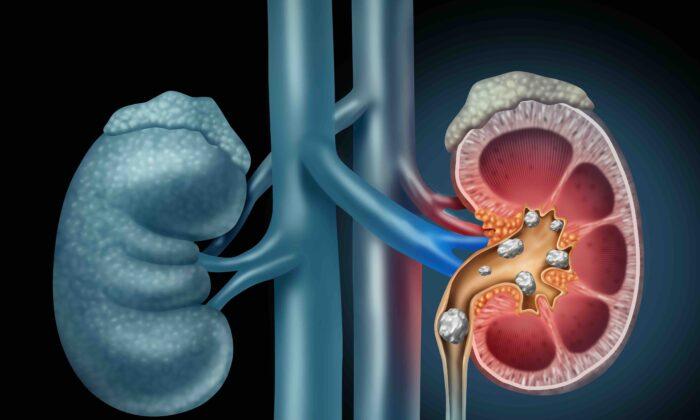 NASA-Funded Kidney Stone Treatment Shows Promise