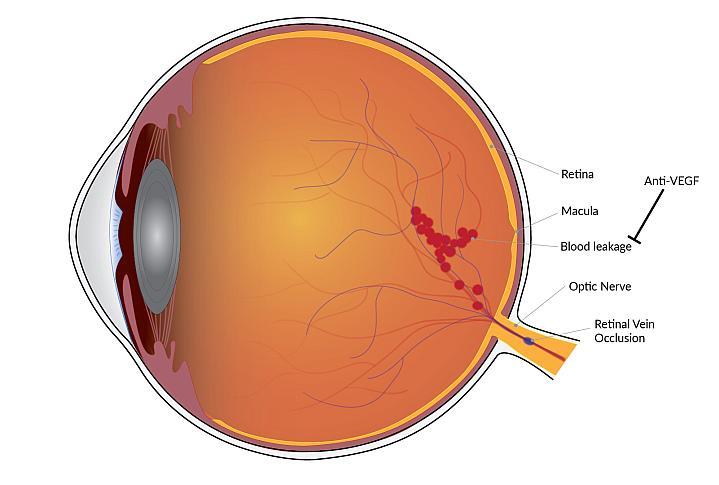 Treating Eye Vein Blockages