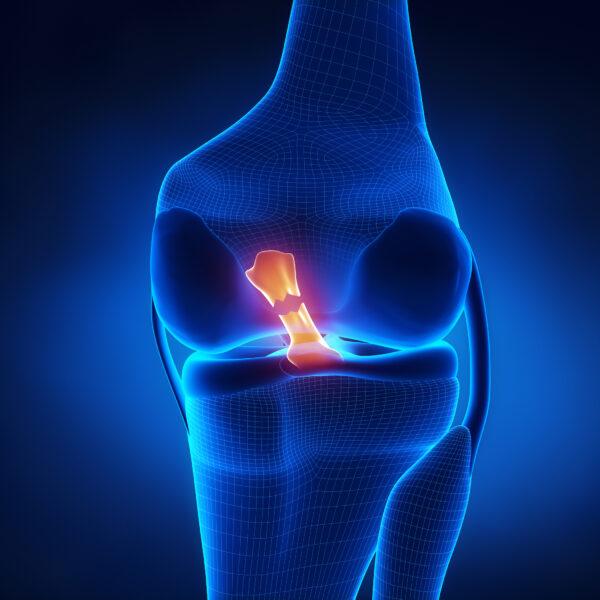 <span class="caption">Torn anterior cruciate ligament is a common injury in sport. </span>(CLIPAREA l Custom media/Shutterstock)