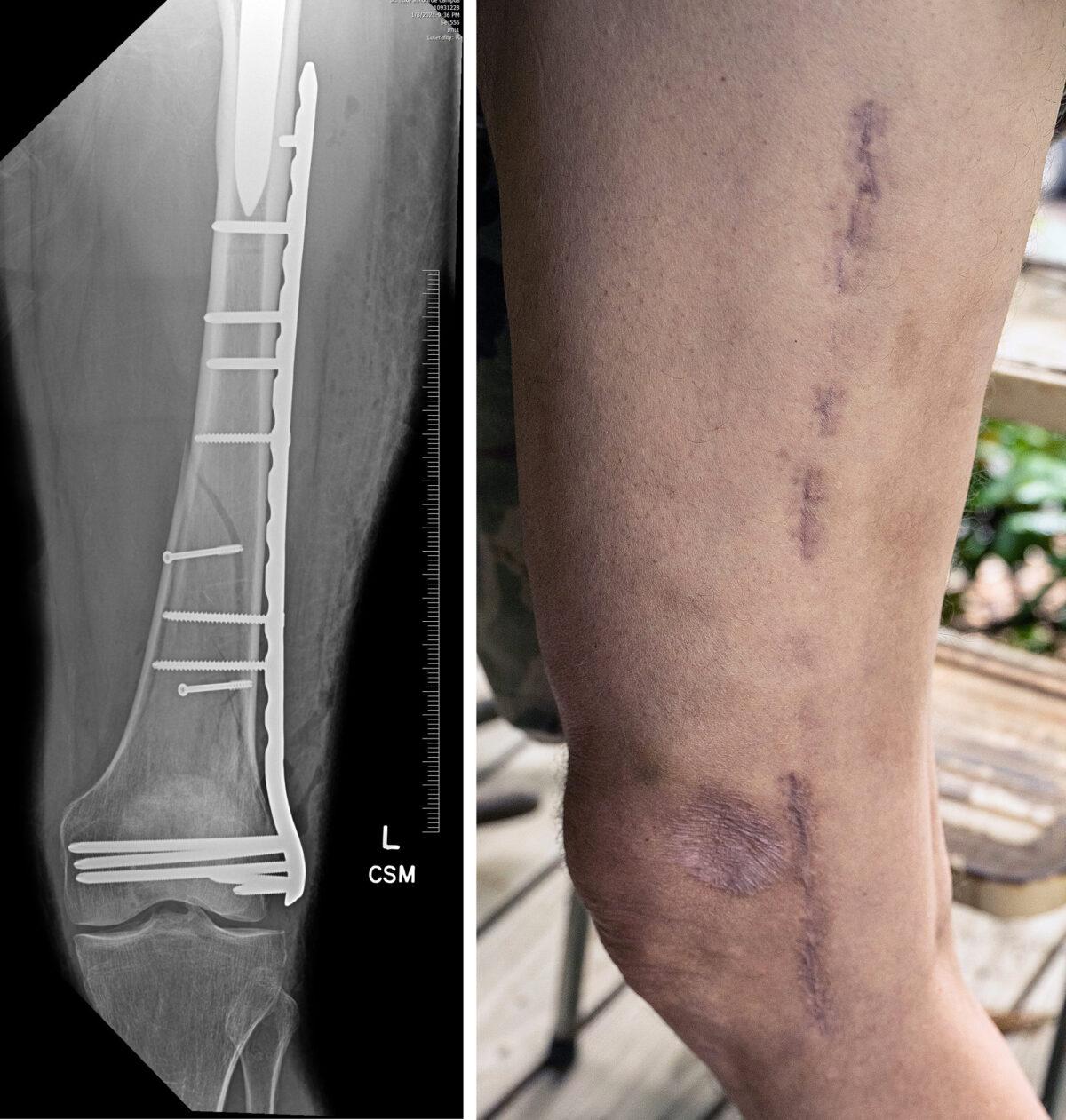 A titanium plate was inserted to splint Mark Griffin's badly fractured leg on Jan. 9, 2021. The plate was finally removed in the spring of 2022. (Left: Mark Griffin; Right: Petr Svab/The Epoch Times)