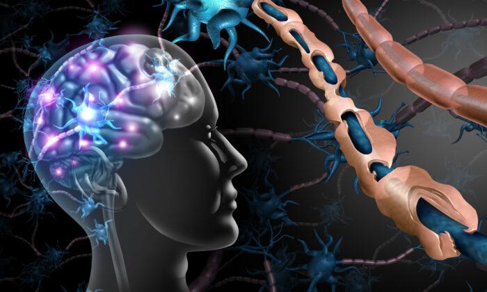 New Study Reveals Surprising Cause of Multiple Sclerosis