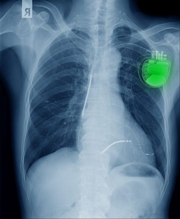 Pacemakers may be another candidate for this technology. (angkhan/Adobe Stock)