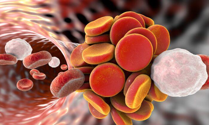Thrombosis vs. Embolism: Symptoms, Causes, and Treatment