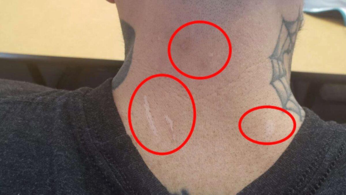 Former D.C. Metropolitan police officer Michael Fanone reveals injuries he sustained on Jan. 6, 2021, after being repeatedly shocked with a taser to the back of his neck, causing burn marks that resulted in scarring. (Courtesy of Department of Justice via The Epoch Times)