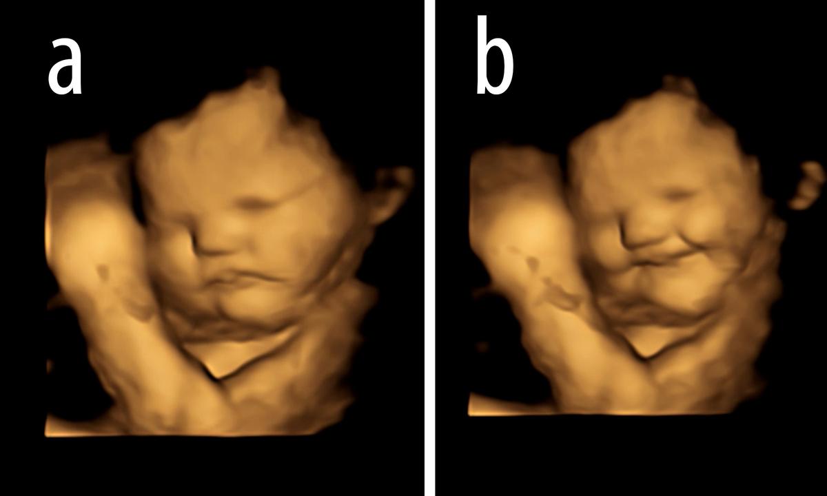 Example of "laughter-face" gestalt shown in a carrot-exposed fetus: (a) baseline, (b) laughter-face gestalt. (Courtesy of FETAP (Fetal Taste Preferences) Study, Fetal and Neonatal Research Lab, Durham University.)