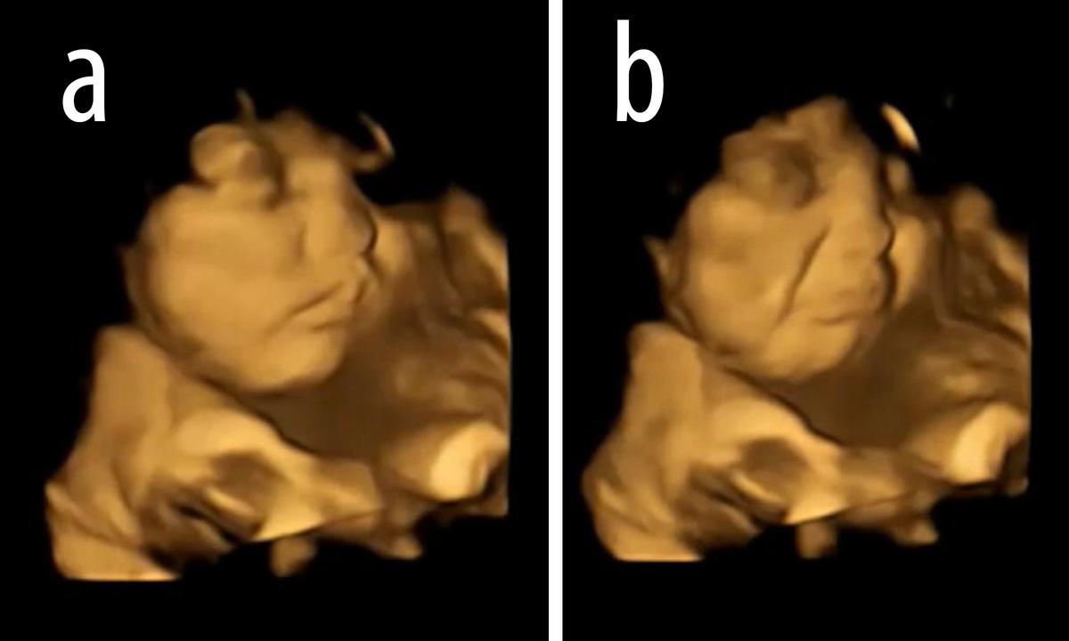Example of "cry-face" gestalt shown in kale-exposed fetus: (a) baseline, (b) cry-face gestalt. (Courtesy of FETAP (Fetal Taste Preferences) Study, Fetal and Neonatal Research Lab, Durham University.)