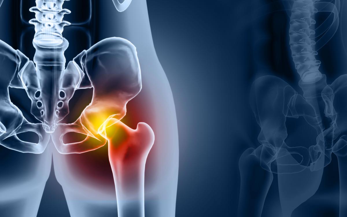 Osteoarthritis Has Doubled in the Last 50 Years