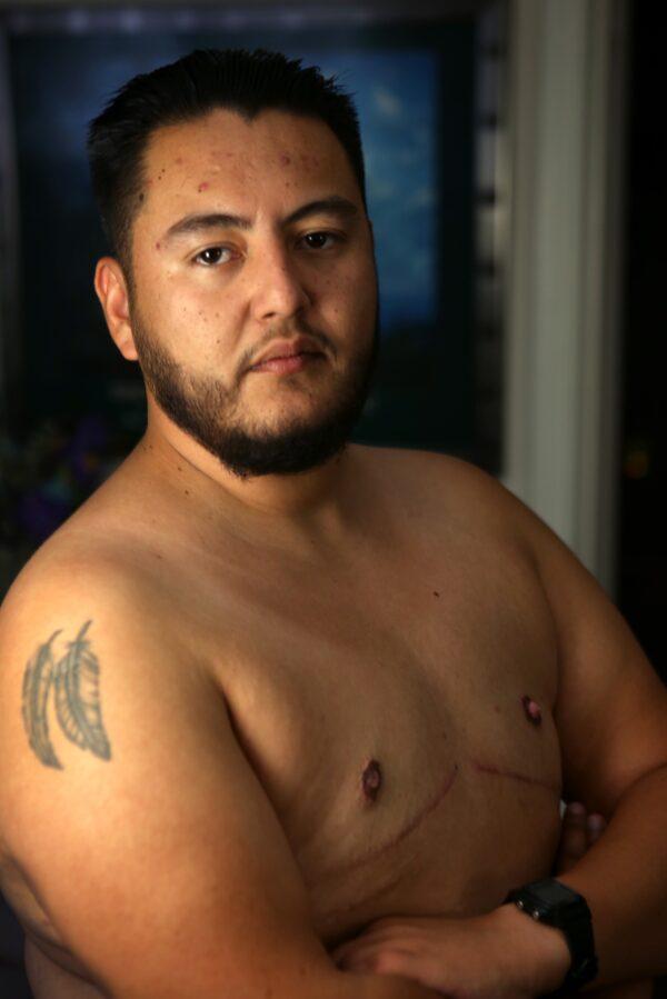 Abel Garcia, photographed at a Dallas home on Sept. 18, 2022, shows his scars from the removal of breast implants. (Bobby Sanchez for The Epoch Times)