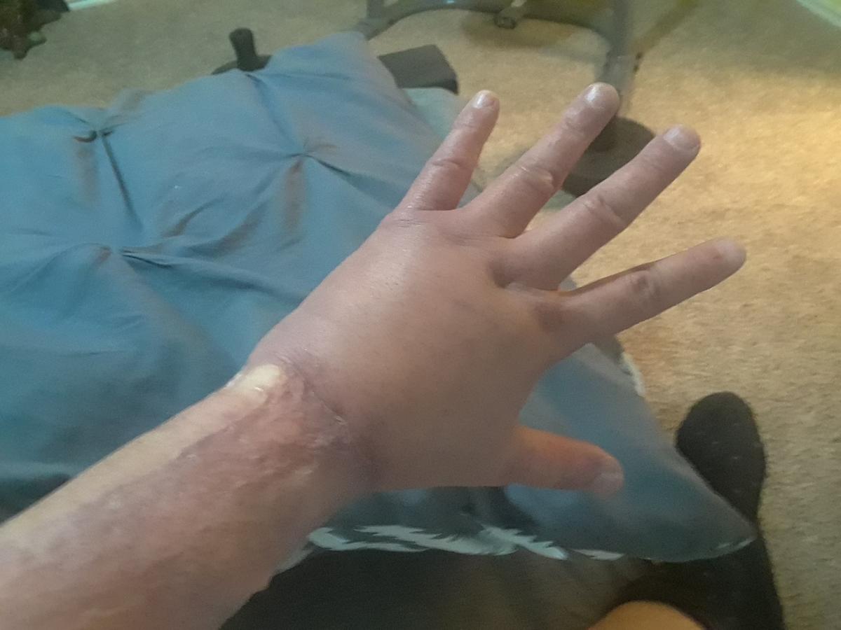Skin was cut from Scott Newgent's arm as part of gender-transition surgery. (Courtesy of Scott Newgent)