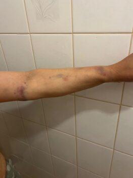 Injuries sustained by Falun Gong practitioner Nancy Dong after an altercation with pro-Beijing men in Canberra, Australia on Oct. 4, 2022. (Courtesy of Nancy Dong)