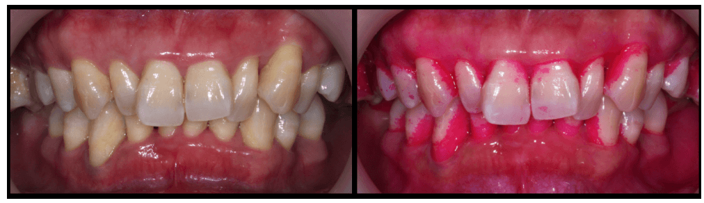 After applying a plaque display agent, we can see that the interdental triangles and the plaques (pink areas) at the tooth necks, which are between the teeth and gums, cannot be easily removed by brushing alone. (Courtesy of Dr. Hsu)