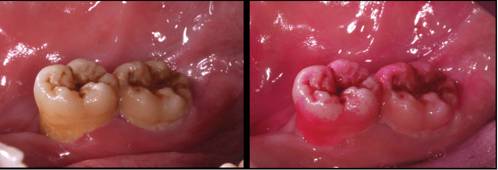 The large pink areas on the inner side of the teeth near the tongue are the result of unremoved plaques. (Courtesy of Dr. Hsu)