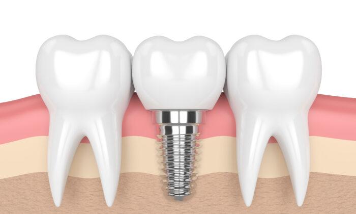 Top Reasons Dental Implants Fail, and What to Look for in a Dentist
