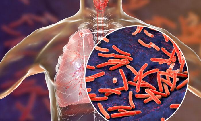 Federal Government Commits 17 Million to Fight Tuberculosis in Asia-Pacific