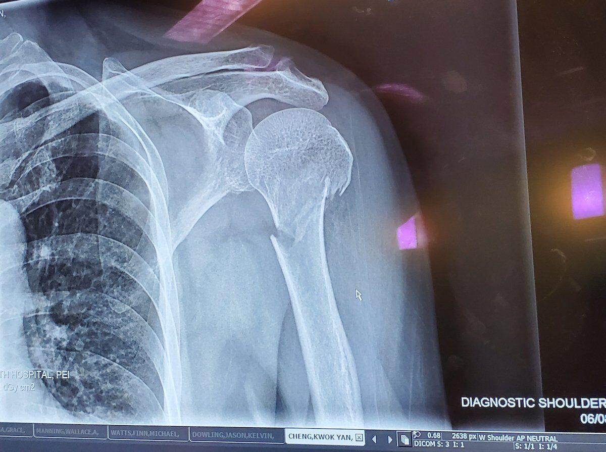 A photo of Cheng's X-ray of her fracture. (Courtesy of Celia Cheng)