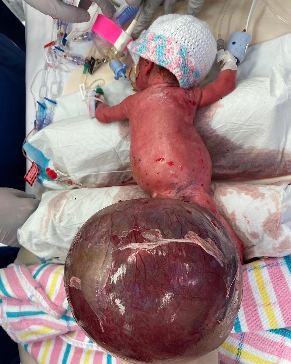 Saylor of North Lakes, Queensland was born with sacrococcygeal teratoma. (Courtesy of <a href="https://www.facebook.com/MaterMothers/">Mater Mothers</a>)