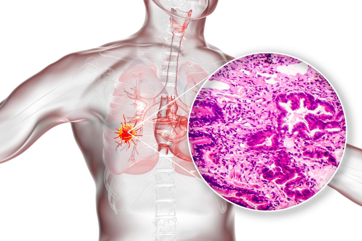 Herb Can Help Avoid Drug Resistance in Treating Lung Cancer: New Study