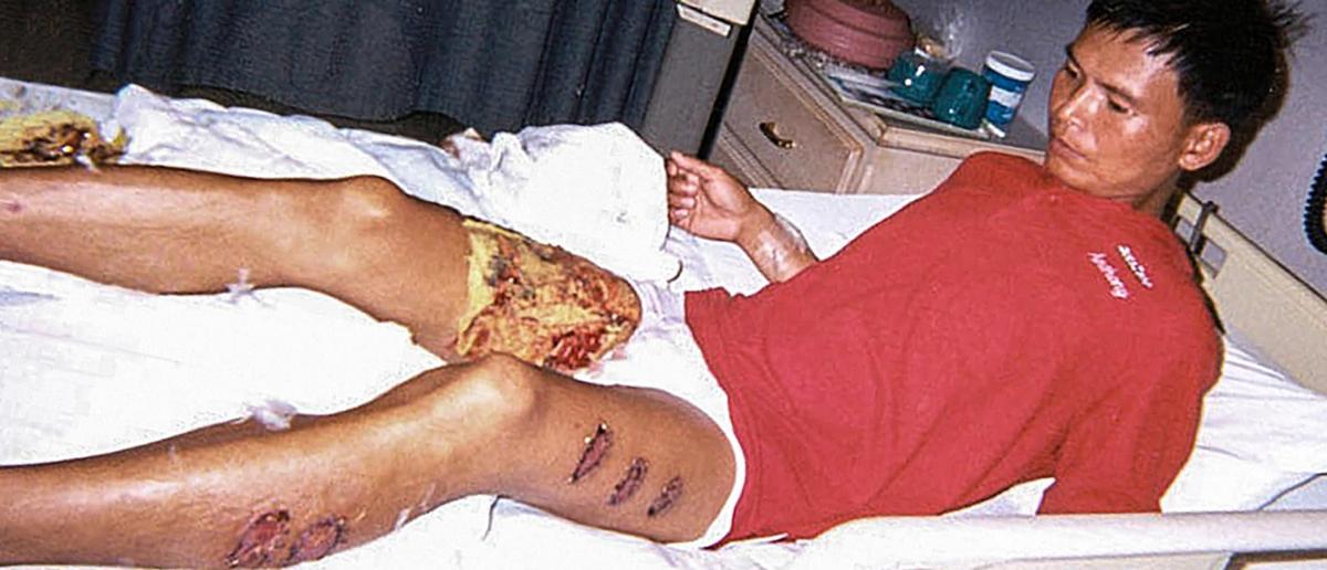 Falun Gong practitioner Tang Yongjie was tortured by prison guards who applied hot rods to his legs a labor camp in the Boluo Area in Guangdong Province, China, in 2001. (Minghui.org)