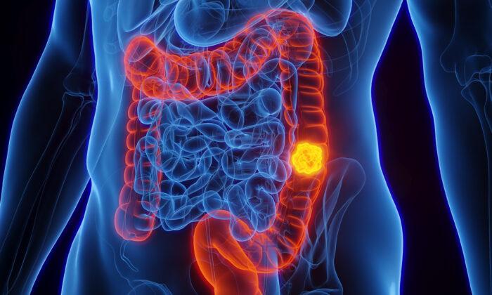 Alarming Surge of Colon Cancer Among Young Adults, Despite Overall Decline: 4 Early Signs That Should Not be Ignored