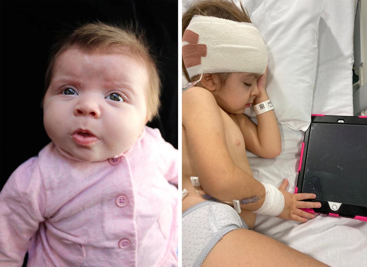 Evie-Mae Geurts, born blind, as an infant and later in the hospital as a toddler. (SWNS)