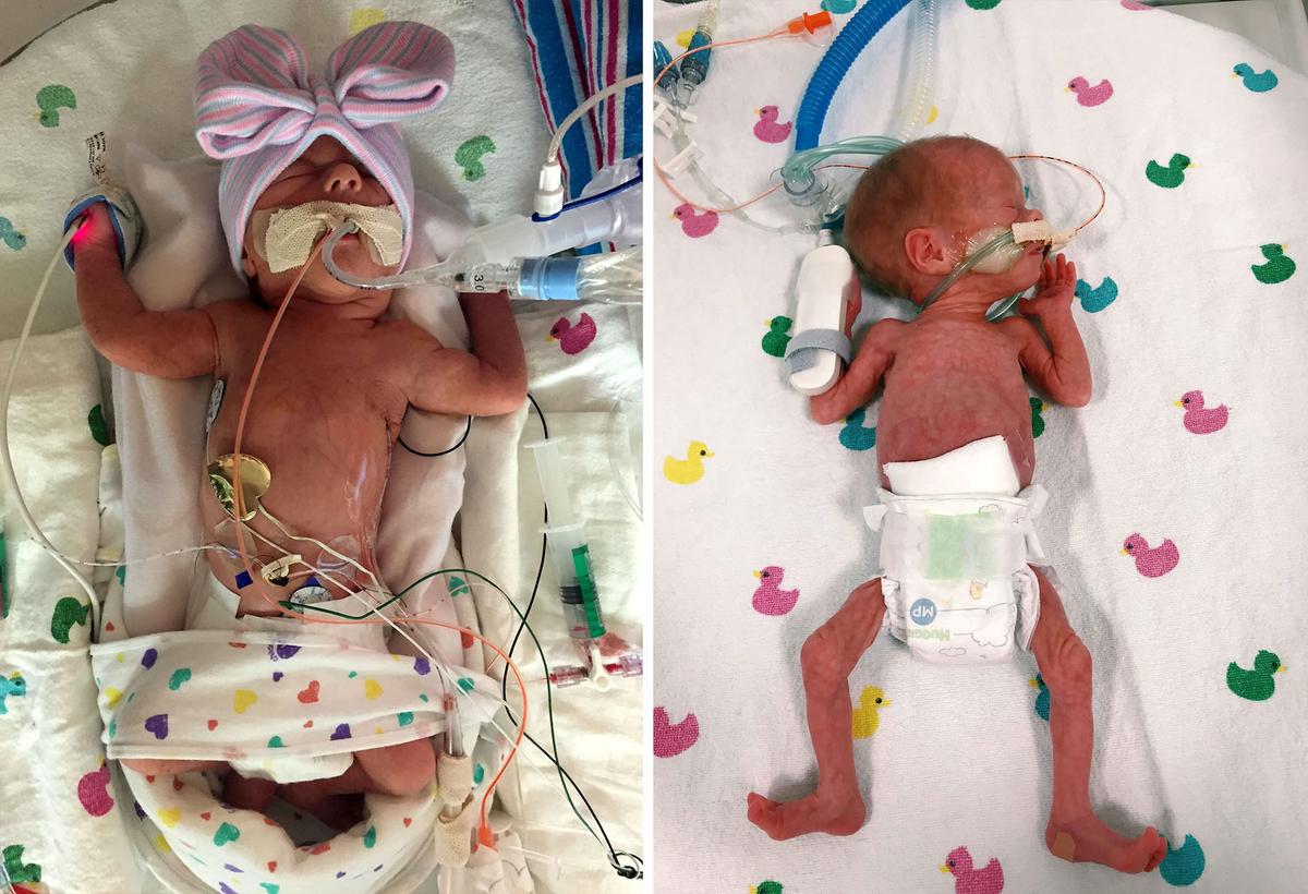 (L) Winnie was born weighing 3 pounds, 8 ounces, and had underdeveloped lungs; (R) Poppy was the smaller of the twins, at 1 pound, 11 ounces, and was perfectly healthy, with nothing wrong with her heart. (SWNS)