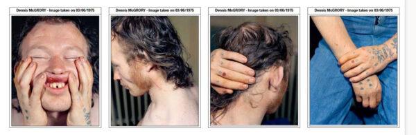 Images showing marks on the face and body of Dennis McGrory, taken after his arrest in London on June 3, 1975. (Crown Prosecution Service)