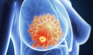 Overdiagnosis of Breast Cancer in Older Women—and Unnecessary Treatment—Is Widespread: Study