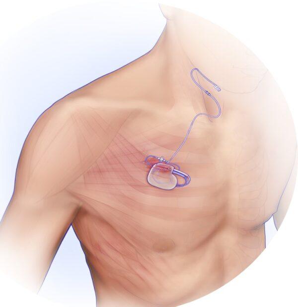 An illustration of where the implanted device is inserted. (Inspire Medical Systems)