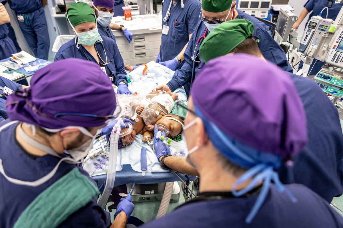 A total of 27 medical staff conducted surgery to separate twins AmieLynn and JamieLynn. (Courtesy of Cook Children's)