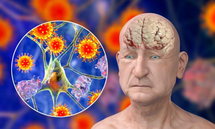 How COVID-19 Accelerates Brain Aging and 1 Way to Protect Yourself