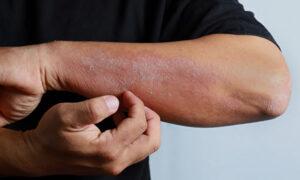 An Ancient Decoction Heals Skin Diseases