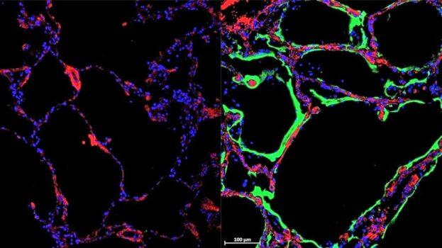 Left: Control Lung. Right: Immunofluorescent staining shows the expression of new SARS-CoV-2 spike-receptor LRRC15 (green) in post-mortem lung tissue section from individuals with COVID-19. (Courtesy of Loo and Waller et al. at the University of Sydney)