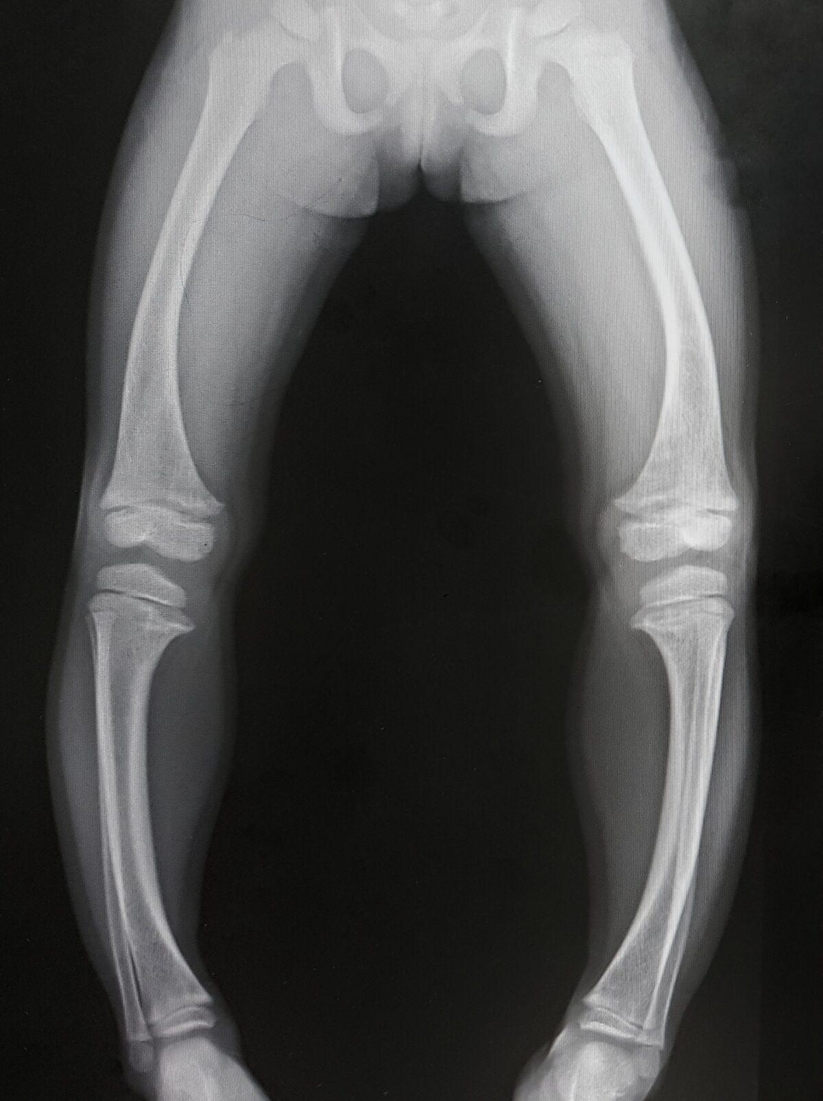 An X-ray of bowed legs, indicative of rickets. (Shutterstock)